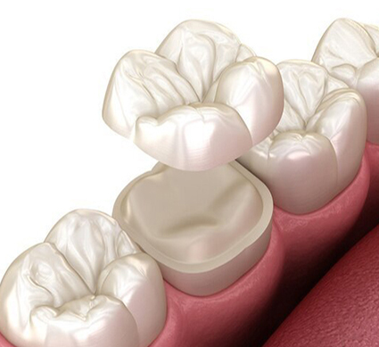 تركيبات الاسنان